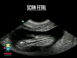 Scan Fetal